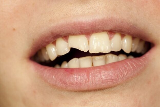 Gigi Patah Dapat Diperbaiki Dengan Melakukan Konsultasi Dan Perawatan Di Dokter Gigi